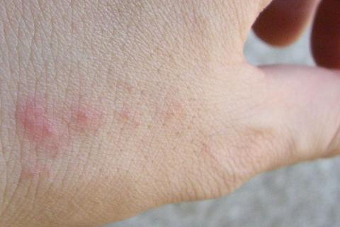 Bed Bug Bite Pictures: Bites on hand.
