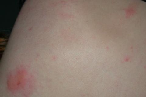 Bed Bug Bite Pictures: Bites on hand.