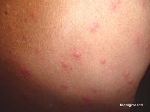 Bed Bug Bite Pictures: Bites from Cyprus.